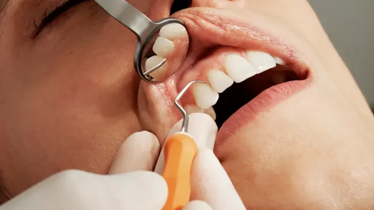 Rêver de perdre ses dents : comprendre ce rêve fréquent